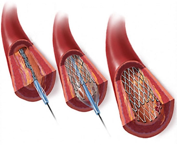 Pasos de angioplastia con stent coronario